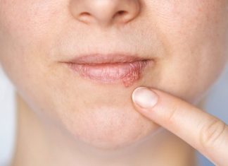 Kada herpes prestaje biti zarazan? Evo što trebate znati
