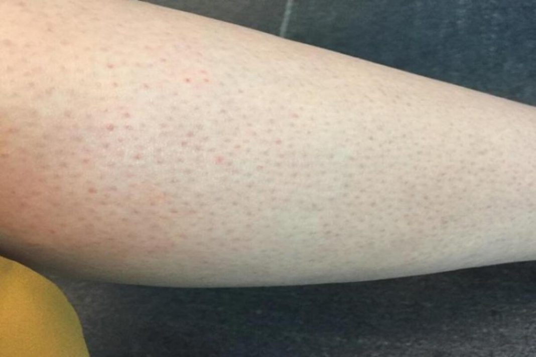 IMATE LI CRVENE TAČKICE NA NOGAMA KAO JAGODE? ŽENE, OBRATITE PAŽNJU, kada čujete 4. razlog, sve će vam biti jasno - featured image