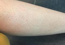 IMATE LI CRVENE TAČKICE NA NOGAMA KAO JAGODE? ŽENE, OBRATITE PAŽNJU, kada čujete 4. razlog, sve će vam biti jasno IMATE LI CRVENE TAČKICE NA NOGAMA KAO JAGODE? ŽENE, OBRATITE PAŽNJU, kada čujete 4. razlog, sve će vam biti jasno - featured image