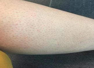 IMATE LI CRVENE TAČKICE NA NOGAMA KAO JAGODE? ŽENE, OBRATITE PAŽNJU, kada čujete 4. razlog, sve će vam biti jasno IMATE LI CRVENE TAČKICE NA NOGAMA KAO JAGODE? ŽENE, OBRATITE PAŽNJU, kada čujete 4. razlog, sve će vam biti jasno - featured image