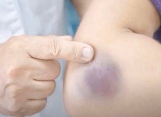 NIKAD NE BISTE POGODILI ZAŠTO SE MODRICE JAVLJAJU PO TIJELU: Nema Veze Sa POVREDAMA, PRAVI RAZLOG ĆE VAS ŠOKIRATI NIKAD NE BISTE POGODILI ZAŠTO SE MODRICE JAVLJAJU PO TIJELU: Nema Veze Sa POVREDAMA, PRAVI RAZLOG ĆE VAS ŠOKIRATI - featured image