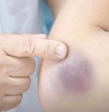 NIKAD NE BISTE POGODILI ZAŠTO SE MODRICE JAVLJAJU PO TIJELU: Nema Veze Sa POVREDAMA, PRAVI RAZLOG ĆE VAS ŠOKIRATI NIKAD NE BISTE POGODILI ZAŠTO SE MODRICE JAVLJAJU PO TIJELU: Nema Veze Sa POVREDAMA, PRAVI RAZLOG ĆE VAS ŠOKIRATI - featured image