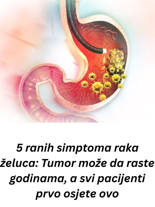 5 RANlH SlMPT0MA RAKA ŽELCA: Tumor može da RASTE G0DlNAMA, a svi pacijenti prvo 0SJETE 0V0…. - featured image