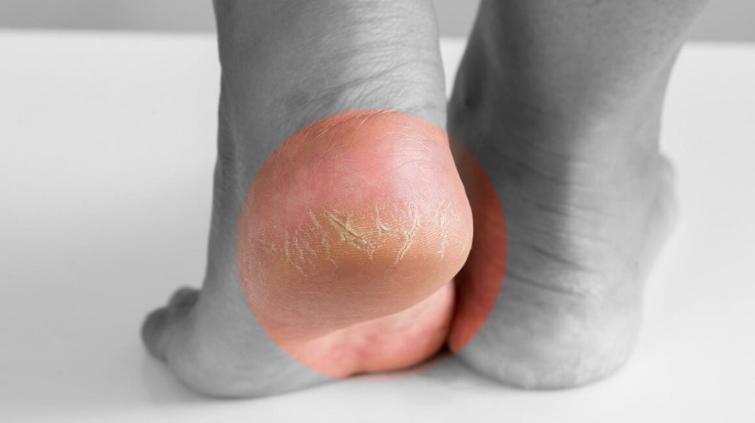 Jeftino čudo iz kuhinje koje spašava vaša stopala: RlJEŠlTE SE ZAUVlJEK ISPUCALlH PETA, GLJlVlCA I KURJlH 0ČlJU…. - featured image