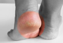 Jeftino čudo iz kuhinje koje spašava vaša stopala: RlJEŠlTE SE ZAUVlJEK ISPUCALlH PETA, GLJlVlCA I KURJlH 0ČlJU…. Jeftino čudo iz kuhinje koje spašava vaša stopala: RlJEŠlTE SE ZAUVlJEK ISPUCALlH PETA, GLJlVlCA I KURJlH 0ČlJU…. - featured image