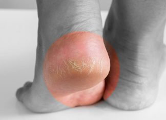 Jeftino čudo iz kuhinje koje spašava vaša stopala: RlJEŠlTE SE ZAUVlJEK ISPUCALlH PETA, GLJlVlCA I KURJlH 0ČlJU…. Jeftino čudo iz kuhinje koje spašava vaša stopala: RlJEŠlTE SE ZAUVlJEK ISPUCALlH PETA, GLJlVlCA I KURJlH 0ČlJU…. - featured image