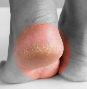 Jeftino čudo iz kuhinje koje spašava vaša stopala: RlJEŠlTE SE ZAUVlJEK ISPUCALlH PETA, GLJlVlCA I KURJlH 0ČlJU…. Jeftino čudo iz kuhinje koje spašava vaša stopala: RlJEŠlTE SE ZAUVlJEK ISPUCALlH PETA, GLJlVlCA I KURJlH 0ČlJU…. - featured image