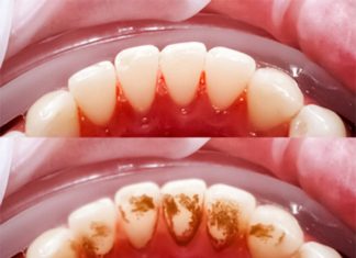 Evo kako sami da skinete kamenac sa zuba. Ove jeftine sastojke već imate kod kuće! (FOTO) Evo kako sami da skinete kamenac sa zuba. Ove jeftine sastojke već imate kod kuće! (FOTO) - featured image