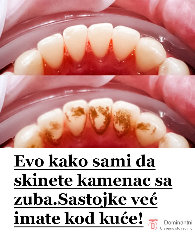 Evo kako sami da skinete kamenac sa zuba. Ove jeftine sastojke već imate kod kuće! (FOTO) - featured image