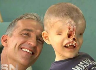 Rođen je BEZ OČIJU I NOSA, roditelji su ga krili, a onda je hirurg izveo ČUDO: “Dječak bez lica” 10 godina kasnije izgleda NEPREPOZNATLJIVO Rođen je BEZ OČIJU I NOSA, roditelji su ga krili, a onda je hirurg izveo ČUDO: "Dječak bez lica" 10 godina kasnije izgleda NEPREPOZNATLJIVO - featured image