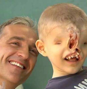 Rođen je BEZ OČIJU I NOSA, roditelji su ga krili, a onda je hirurg izveo ČUDO: “Dječak bez lica” 10 godina kasnije izgleda NEPREPOZNATLJIVO Rođen je BEZ OČIJU I NOSA, roditelji su ga krili, a onda je hirurg izveo ČUDO: "Dječak bez lica" 10 godina kasnije izgleda NEPREPOZNATLJIVO - featured image