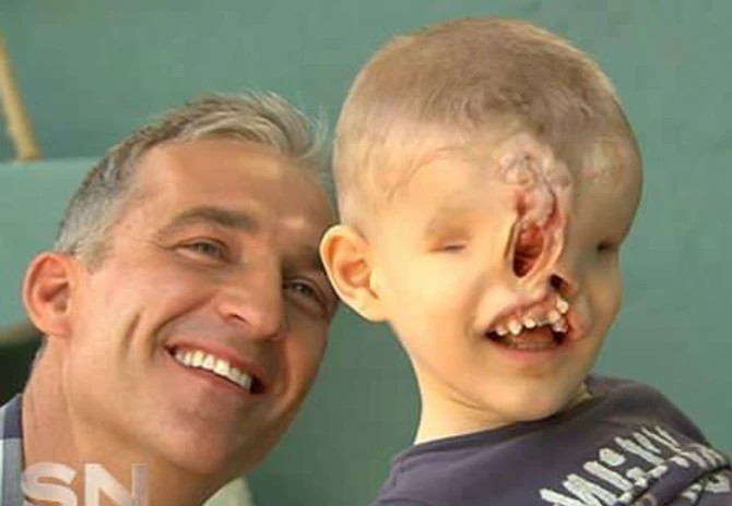 Rođen je BEZ OČIJU I NOSA, roditelji su ga krili, a onda je hirurg izveo ČUDO: 