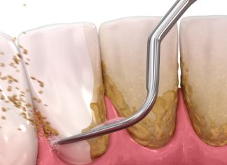 Evo kako sami da skinete kamenac sa zuba. Ove jeftine sastojke već imate kod kuće! (FOTO) Evo kako sami da skinete kamenac sa zuba. Ove jeftine sastojke već imate kod kuće! (FOTO) - featured image