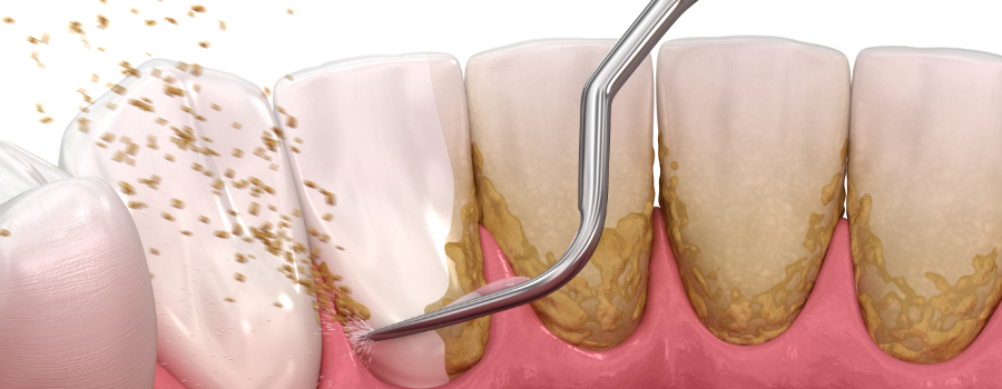 Evo kako sami da skinete kamenac sa zuba. Ove jeftine sastojke već imate kod kuće! (FOTO) - featured image
