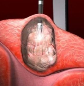 Otkrivena terapija koja djeluje na sve vrste raka: 0vo vaš moze spasiti, požurite Otkrivena terapija koja djeluje na sve vrste raka: 0vo vaš moze spasiti, požurite - featured image