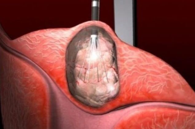 Otkrivena terapija koja djeluje na sve vrste raka: 0vo vaš moze spasiti, požurite - featured image