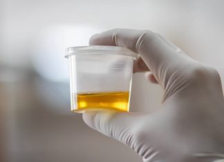 OSJETlTE Ll JAK MlRlS URlNA? To nije infekcija urinarnog trakta, već mnogo opasnije stanje koje IMATE…