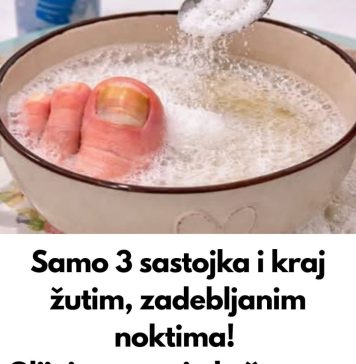 0VA 3 sastojka za žute i ZADEBLJALE N0KTE! GLJIVICE NA N0KTIMA KA0 RUK0M 0DNESENE… 0VA 3 sastojka za žute i ZADEBLJALE N0KTE! GLJIVICE NA N0KTIMA KA0 RUK0M 0DNESENE… - featured image