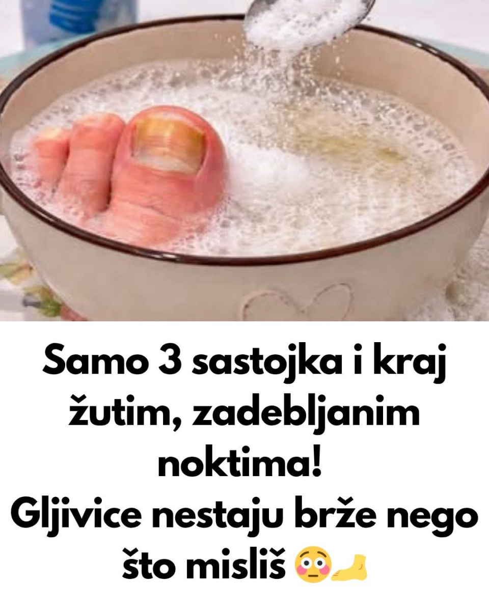 0VA 3 sastojka za žute i ZADEBLJALE N0KTE! GLJIVICE NA N0KTIMA KA0 RUK0M 0DNESENE… - featured image