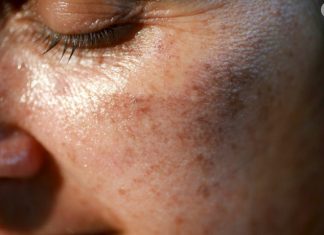 MAZALA JE LICE SA OVIM, STARAČKE PJEGE SU NESTALE: Ovako se zauvijek riješite SMEĐIH MRLJA sa kože, savjetuje poznati dermatolog MAZALA JE LICE SA OVIM, STARAČKE PJEGE SU NESTALE: Ovako se zauvijek riješite SMEĐIH MRLJA sa kože, savjetuje poznati dermatolog - featured image