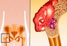 Bol u kostima, visok pritisak i tuga: Tijelo vam govori da mu NEDOSTAJE ovaj važan VITAMIN Bol u kostima, visok pritisak i tuga: Tijelo vam govori da mu NEDOSTAJE ovaj važan VITAMIN - featured image