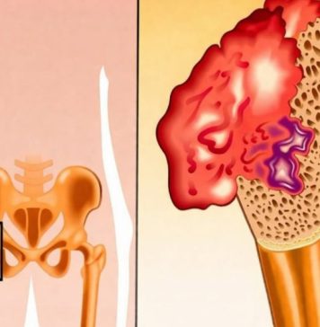 Bol u kostima, visok pritisak i tuga: Tijelo vam govori da mu NEDOSTAJE ovaj važan VITAMIN Bol u kostima, visok pritisak i tuga: Tijelo vam govori da mu NEDOSTAJE ovaj važan VITAMIN - featured image