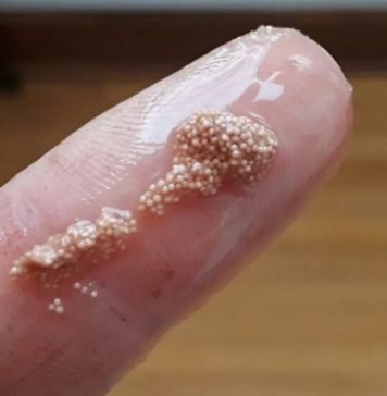 Bele grudvice u jajetu: šta to zaista znači i da li treba da brinete? Bele grudvice u jajetu: šta to zaista znači i da li treba da brinete? - featured image