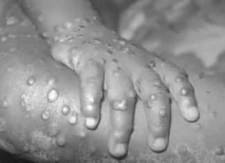 U zemlji pored naše širi se smrtonosan virus: 446 zaraženih, najugroženija je jedna grupa ljudi U zemlji pored naše širi se smrtonosan virus: 446 zaraženih, najugroženija je jedna grupa ljudi - featured image