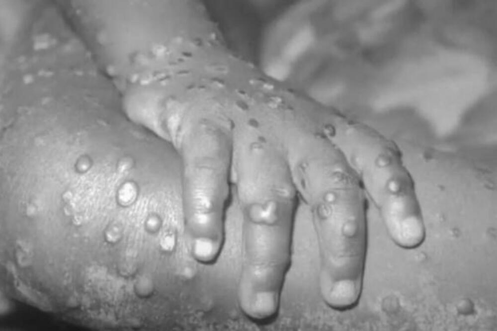 U zemlji pored naše širi se smrtonosan virus: 446 zaraženih, najugroženija je jedna grupa ljudi - featured image U zemlji pored naše širi se smrtonosan virus: 446 zaraženih, najugroženija je jedna grupa ljudi - featured image