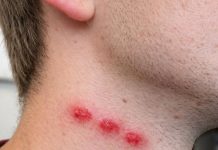 Crveni tragovi u nizu na koži mogu biti prvi znak da se u domu krije problem sa… Crveni tragovi u nizu na koži mogu biti prvi znak da se u domu krije problem sa stjenicama - featured image