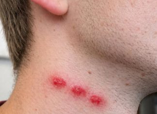 Crveni tragovi u nizu na koži mogu biti prvi znak da se u domu krije problem sa… Crveni tragovi u nizu na koži mogu biti prvi znak da se u domu krije problem sa stjenicama - featured image
