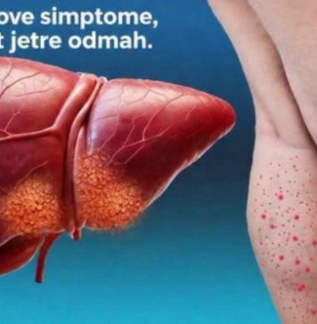 DA LI JE VAŠA JETRA U OPASNOSTI? Ovo je 12 ranih znakova ciroze jetre koje ne smete da ignorišete DA LI JE VAŠA JETRA U OPASNOSTI? Ovo je 12 ranih znakova ciroze jetre koje ne smete da ignorišete - featured image