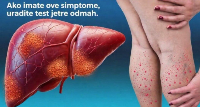 DA LI JE VAŠA JETRA U OPASNOSTI? Ovo je 12 ranih znakova ciroze jetre koje ne smete da ignorišete - featured image